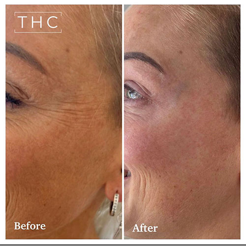 anti-wrinkle-treatment-bedford-10