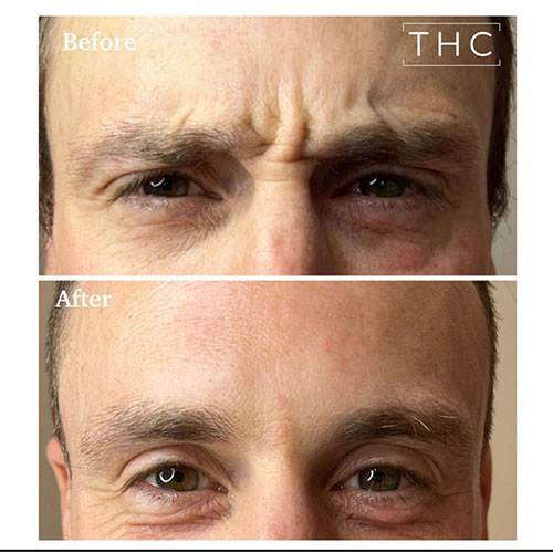 anti-wrinkle-treatment-bedford-11