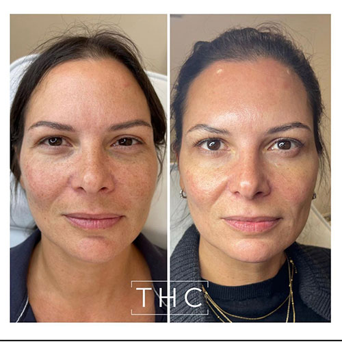 anti-wrinkle-treatment-bedford-12