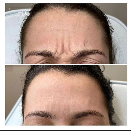 anti-wrinkle-treatment-bedford-13