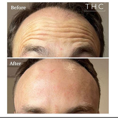 anti-wrinkle-treatment-bedford-14