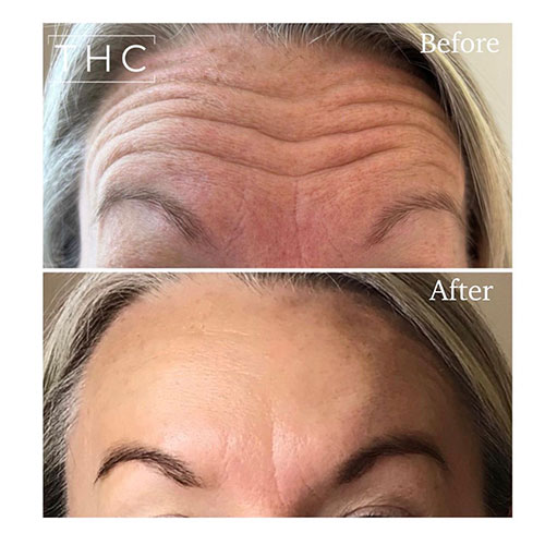 anti-wrinkle-treatment-bedford-15