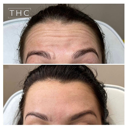 anti-wrinkle-treatment-bedford-16