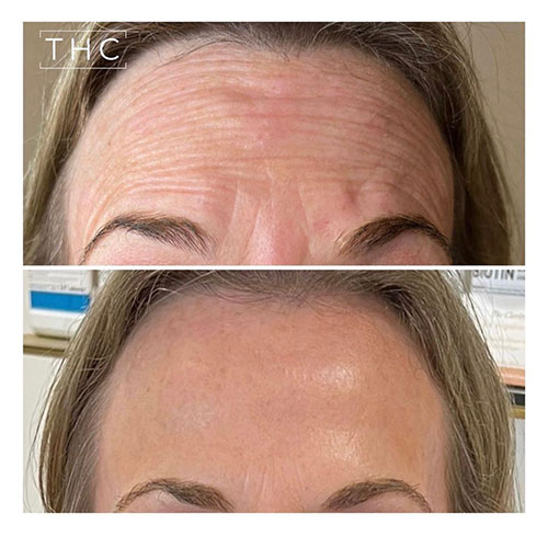 anti-wrinkle-treatment-bedford-17