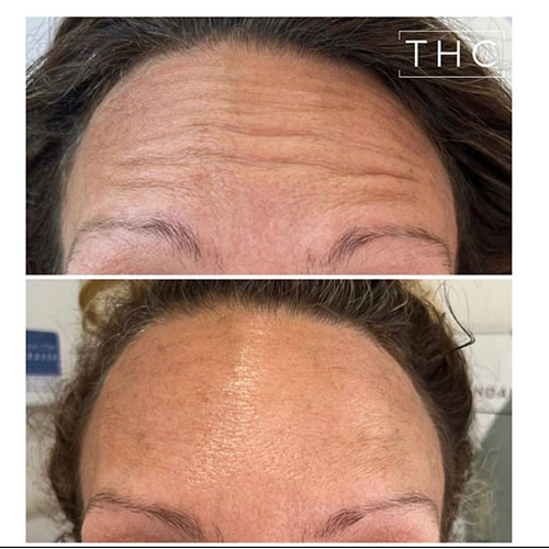 anti-wrinkle-treatment-bedford-2