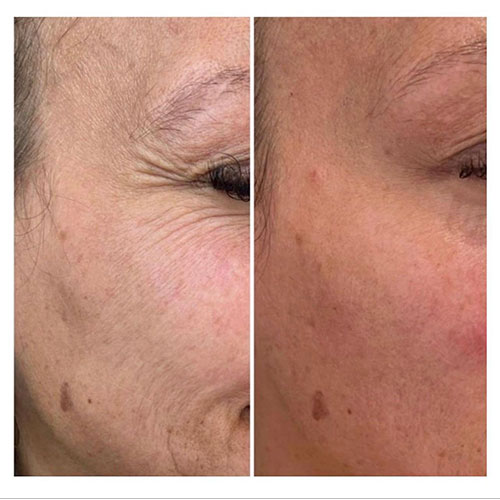 anti-wrinkle-treatment-bedford-4