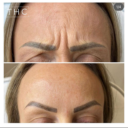 anti-wrinkle-treatment-bedford-6