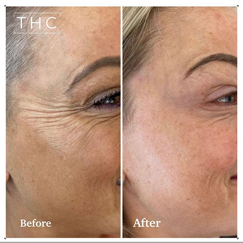 anti-wrinkle-treatment-bedford-7
