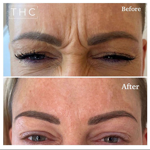 anti-wrinkle-treatment-bedford-9