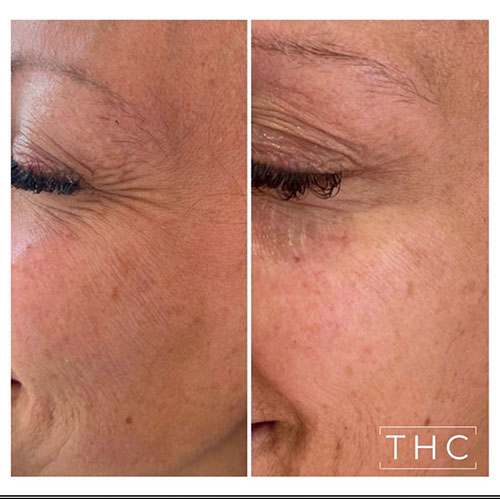 anti-wrinkle-treatment-bedford
