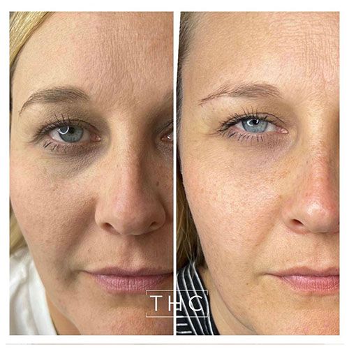light-eyes-treatment-bedford-1
