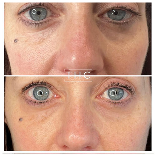 light-eyes-treatment-bedford-2