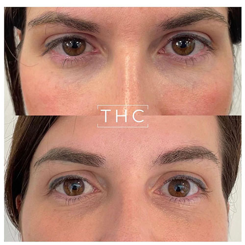 light-eyes-treatment-bedford-3