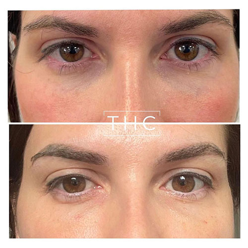 light-eyes-treatment-bedford-4