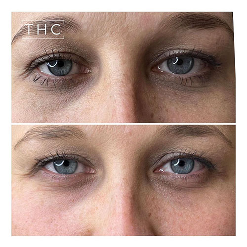 light-eyes-treatment-bedford-5