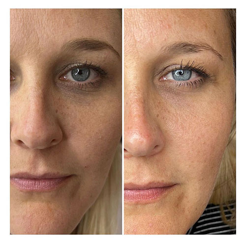 light-eyes-treatment-bedford-6