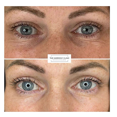 light-eyes-treatment-bedford-7