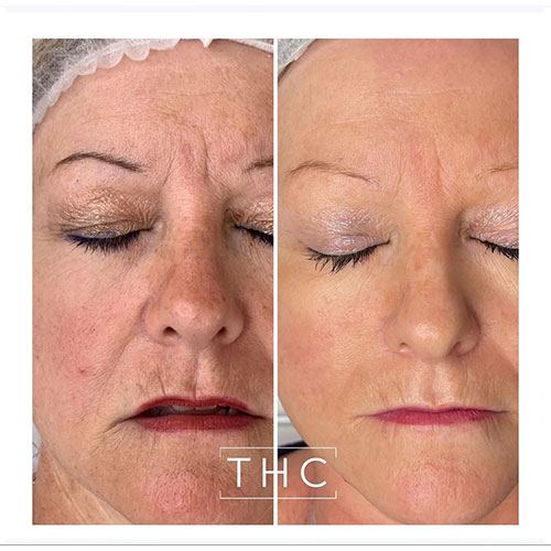 micro-needling-bedford-1