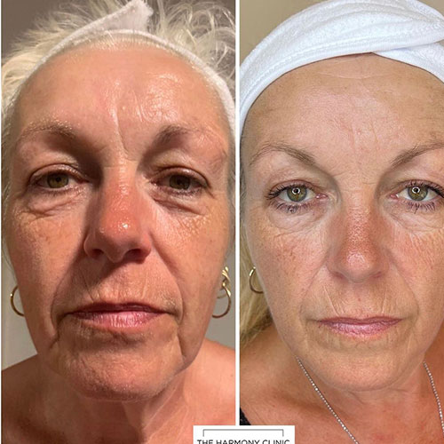 micro-needling-bedford-10