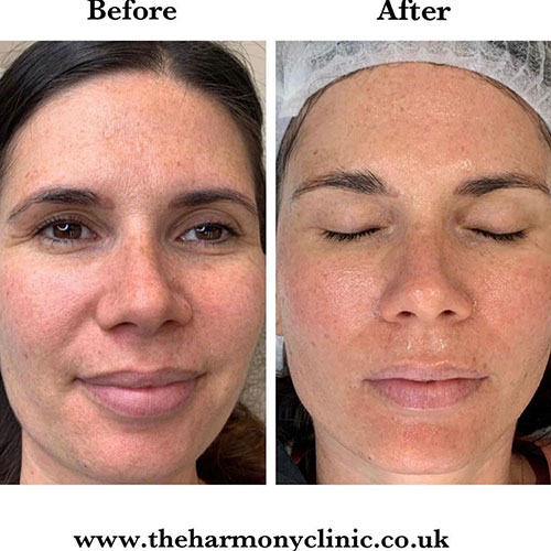 micro-needling-bedford-12