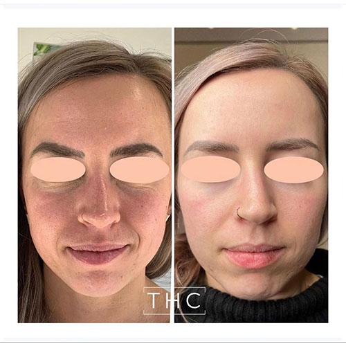 micro-needling-bedford-2