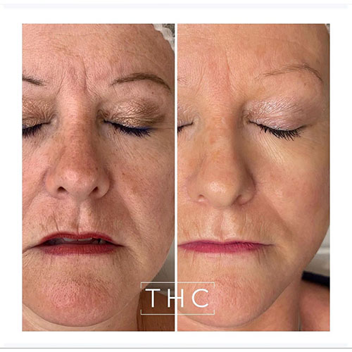 micro-needling-bedford-3