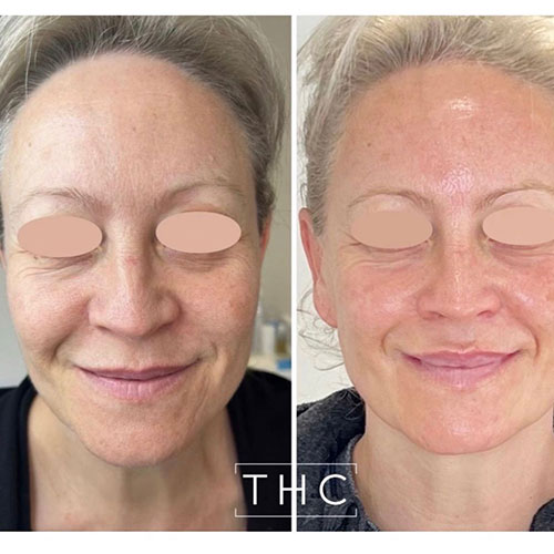 micro-needling-bedford-4
