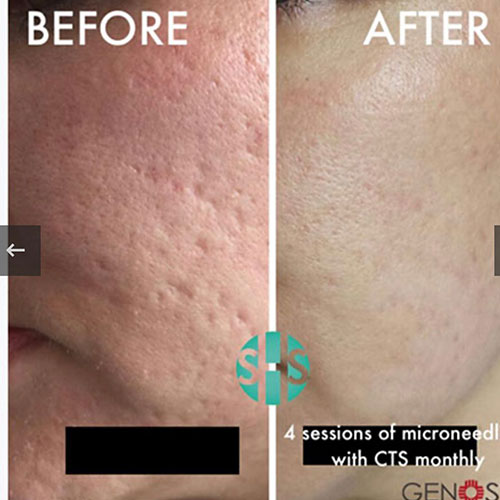 micro-needling-bedford-5