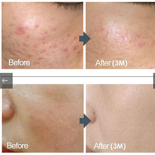 micro-needling-bedford-6