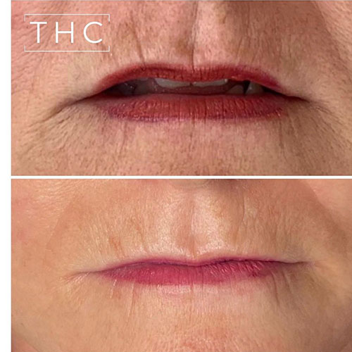 micro-needling-bedford-7