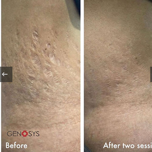 micro-needling-bedford-8