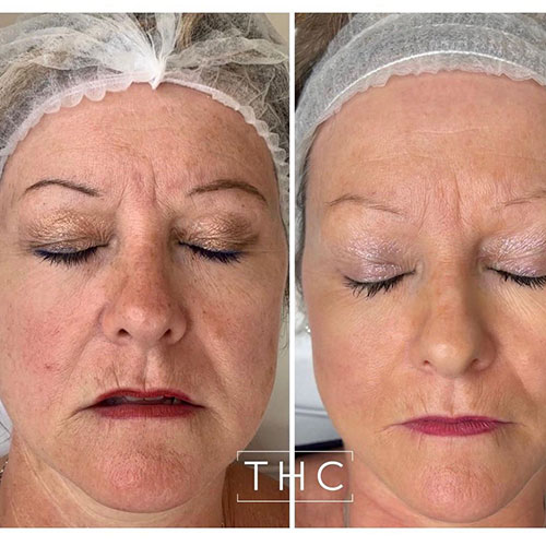 micro-needling-bedford-9
