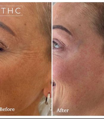 anti-wrinkle-treatment-bedford-10