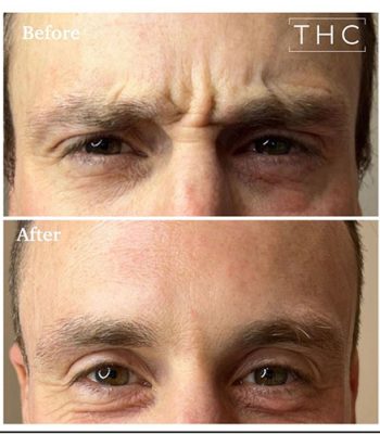 anti-wrinkle-treatment-bedford-11