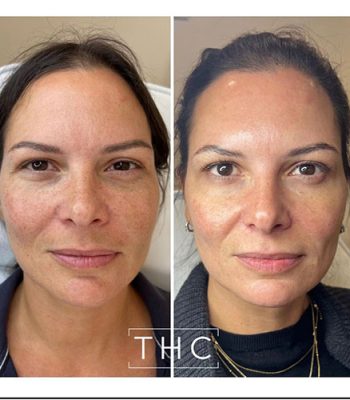 anti-wrinkle-treatment-bedford-12