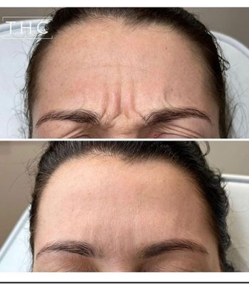 anti-wrinkle-treatment-bedford-13