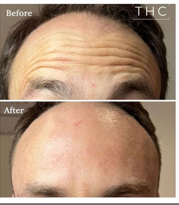 anti-wrinkle-treatment-bedford-14