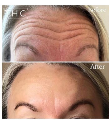 anti-wrinkle-treatment-bedford-15