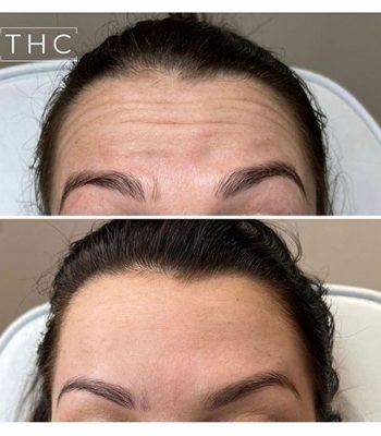 anti-wrinkle-treatment-bedford-16