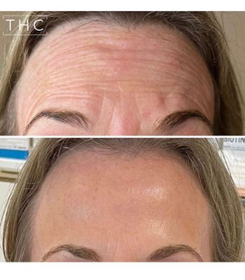 anti-wrinkle-treatment-bedford-17