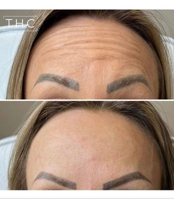 anti-wrinkle-treatment-bedford-3