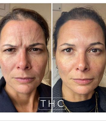 anti-wrinkle-treatment-bedford-5