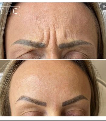 anti-wrinkle-treatment-bedford-6