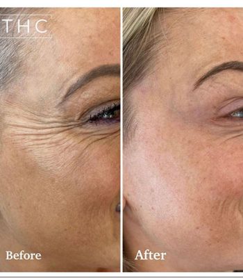 anti-wrinkle-treatment-bedford-8