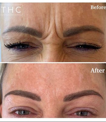 anti-wrinkle-treatment-bedford-9
