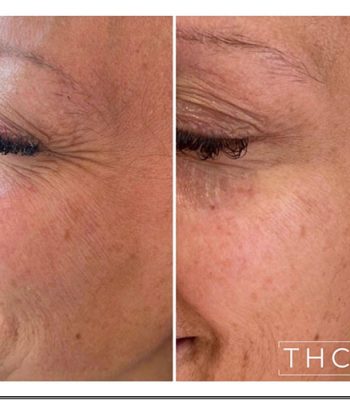 anti-wrinkle-treatment-bedford