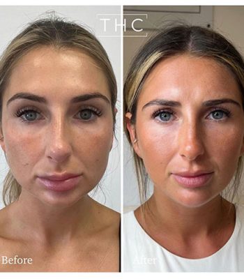 chemical-skin-peal-bedford-7