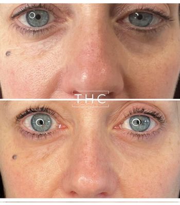 light-eyes-treatment-bedford-2