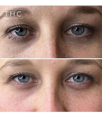 light-eyes-treatment-bedford-5