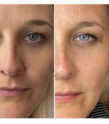 light-eyes-treatment-bedford-6